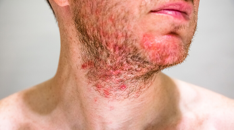 Dermatitis seborreica: qué es, síntomas y tratamientos